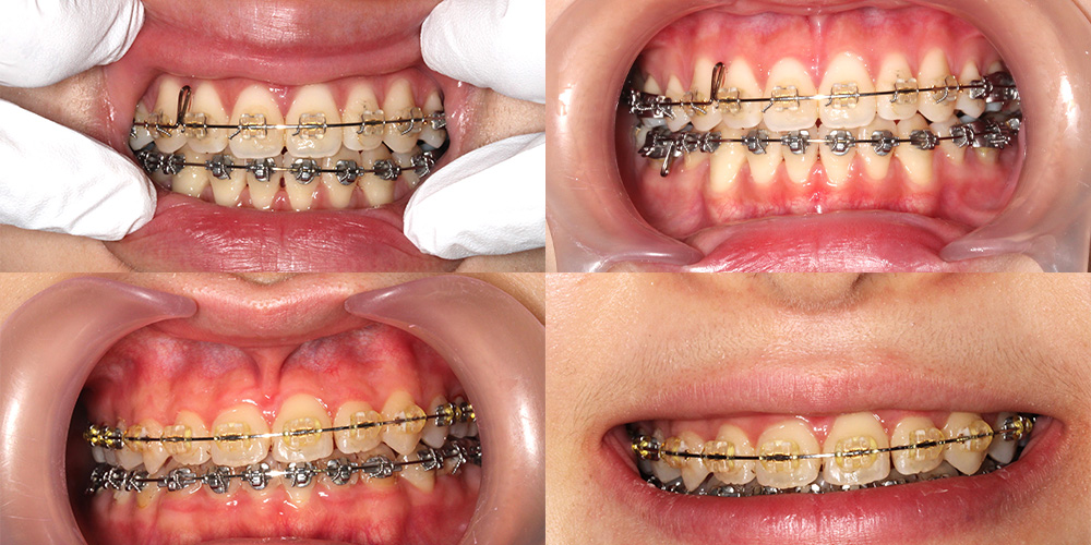 経験豊富な院長が小児矯正を担当